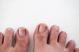 toenail ablation